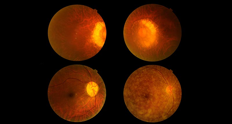 The Power of OCT Imaging for Protecting Eye Health